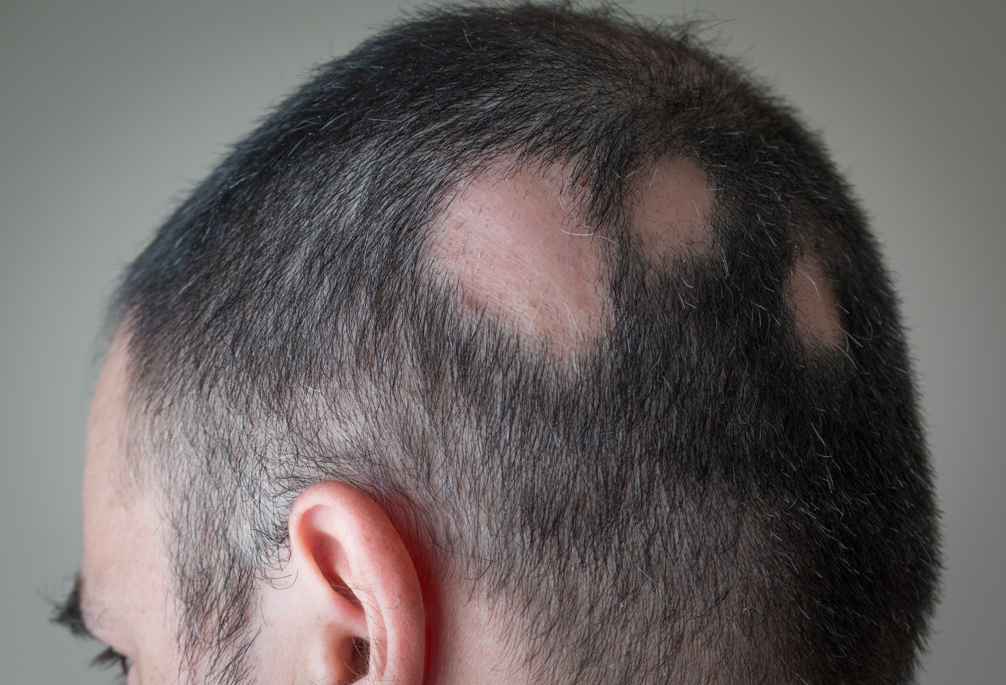 New Alopecia Treatment Could Be Breakthrough For Hair Growth