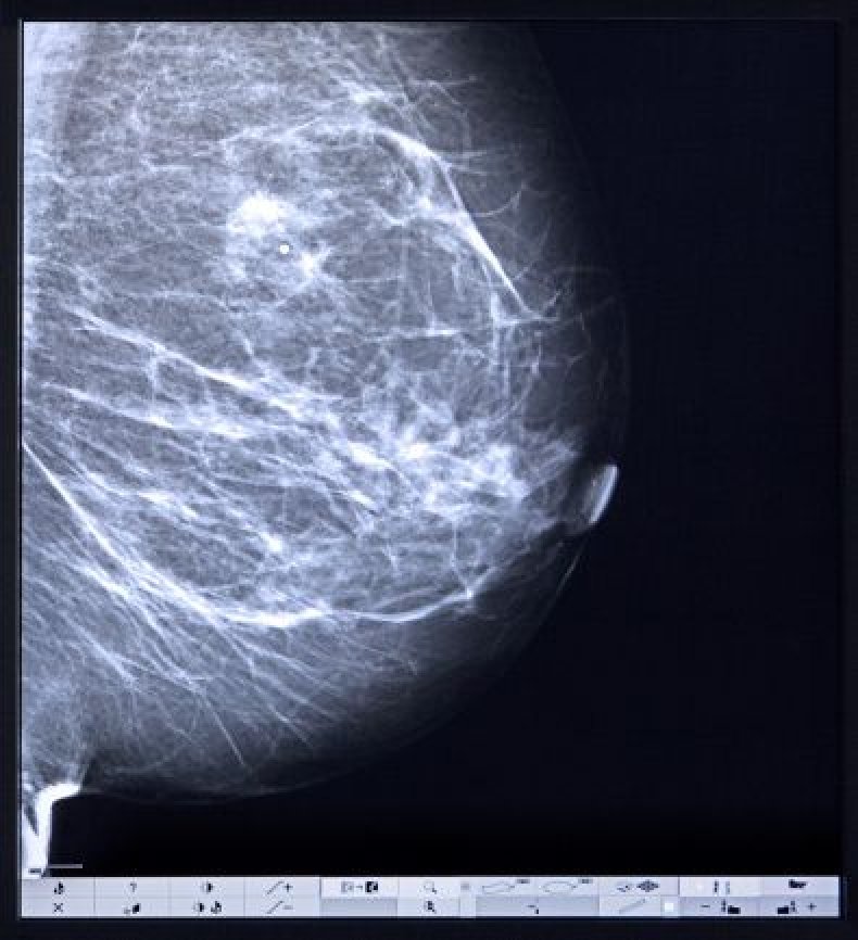 0706-mammogram2