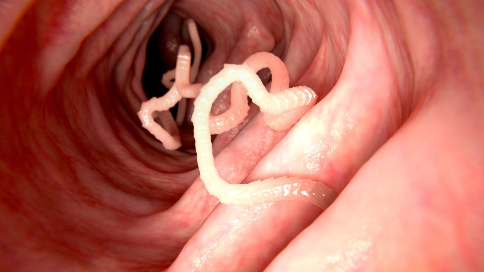 What Is A Hookworm Parasite Infects Teen Boy As Friends Bury Him In Sand At Florida Beach What Is A Hookworm Parasite Infects Teen Boy As Friends Bury Him In Sand At Florida Beach
