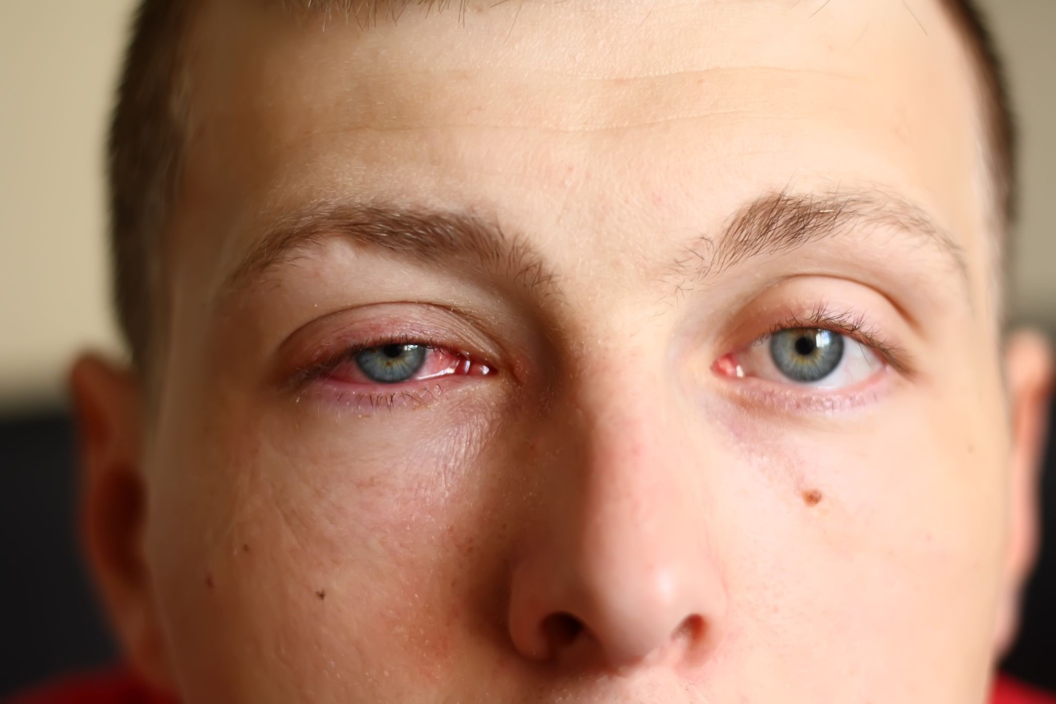 pink-eye-conjunctivitis-stock 