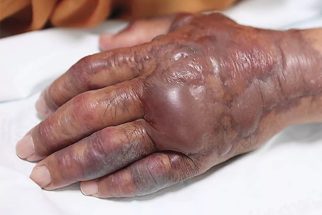 A 71-Year-Old Man with Blisters on the Face and a Painful Left