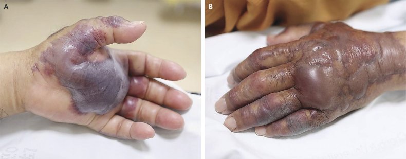 nejm