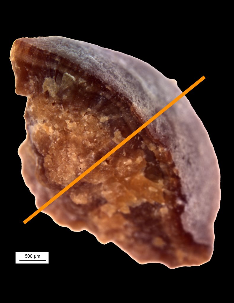 kidney-stones