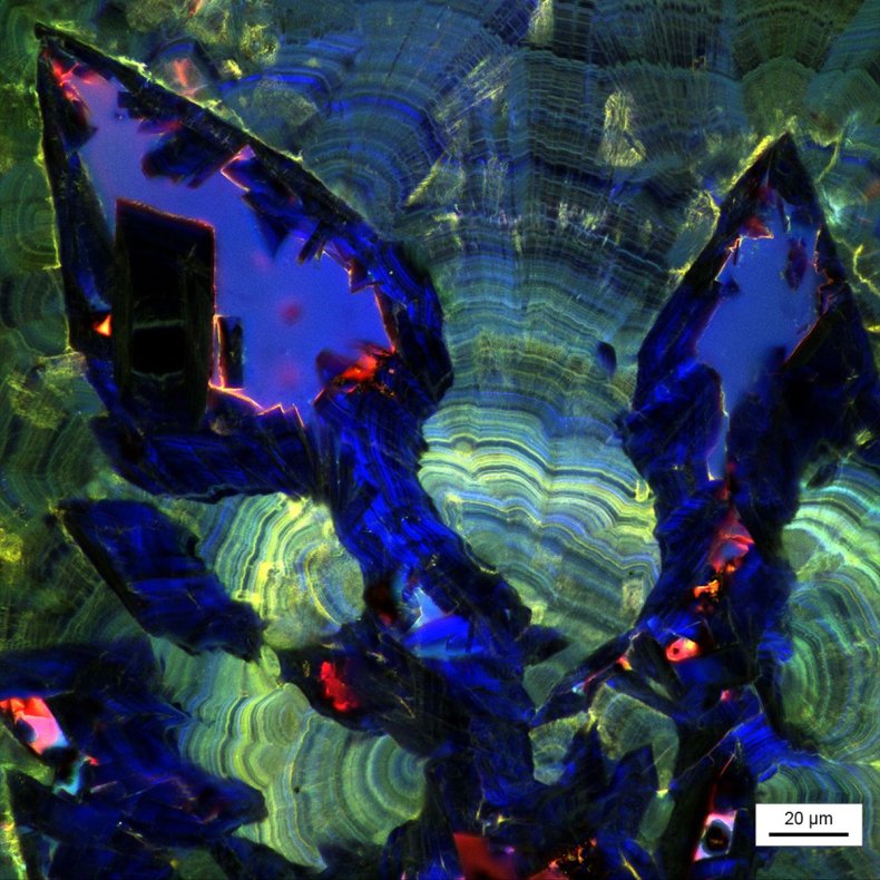 kidney stones2