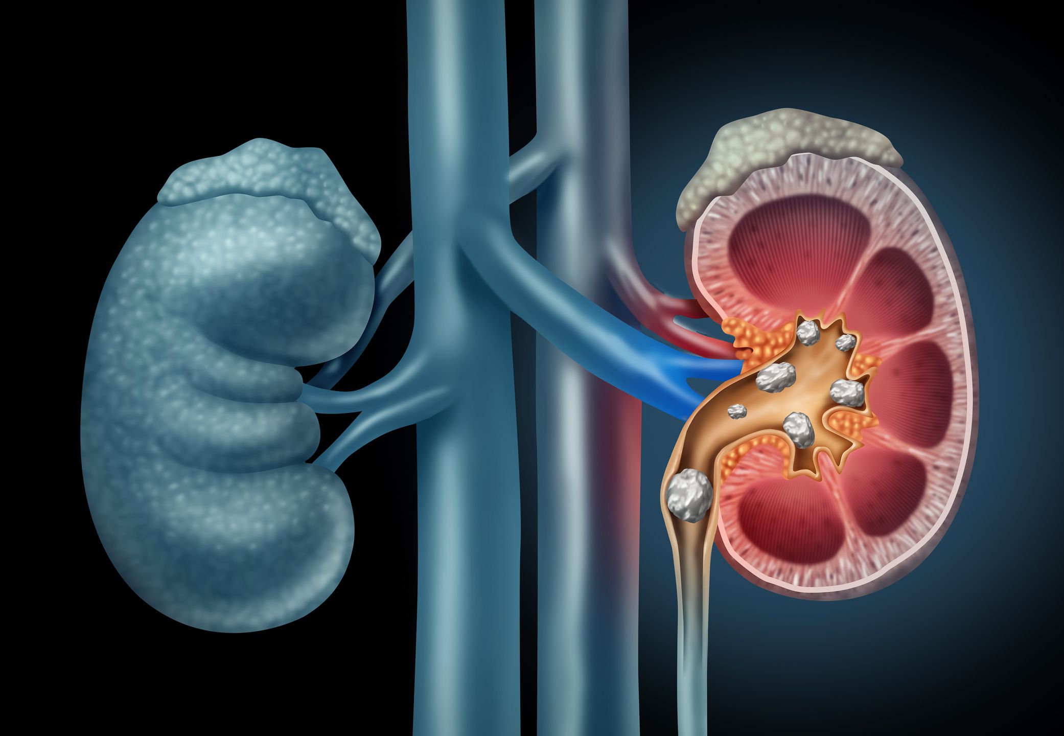 dissolve kidney stones