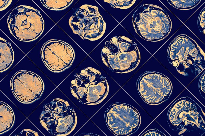 brain-xray-stock