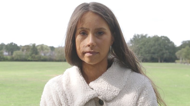 acid victim katie gee