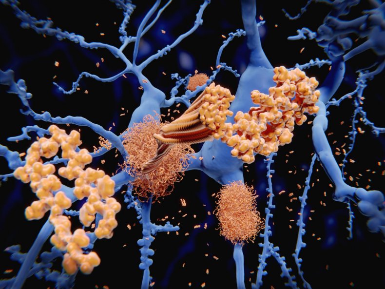 9_28_Alzheimer's disease