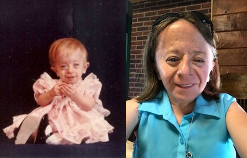 Saul-Wilson Syndrome