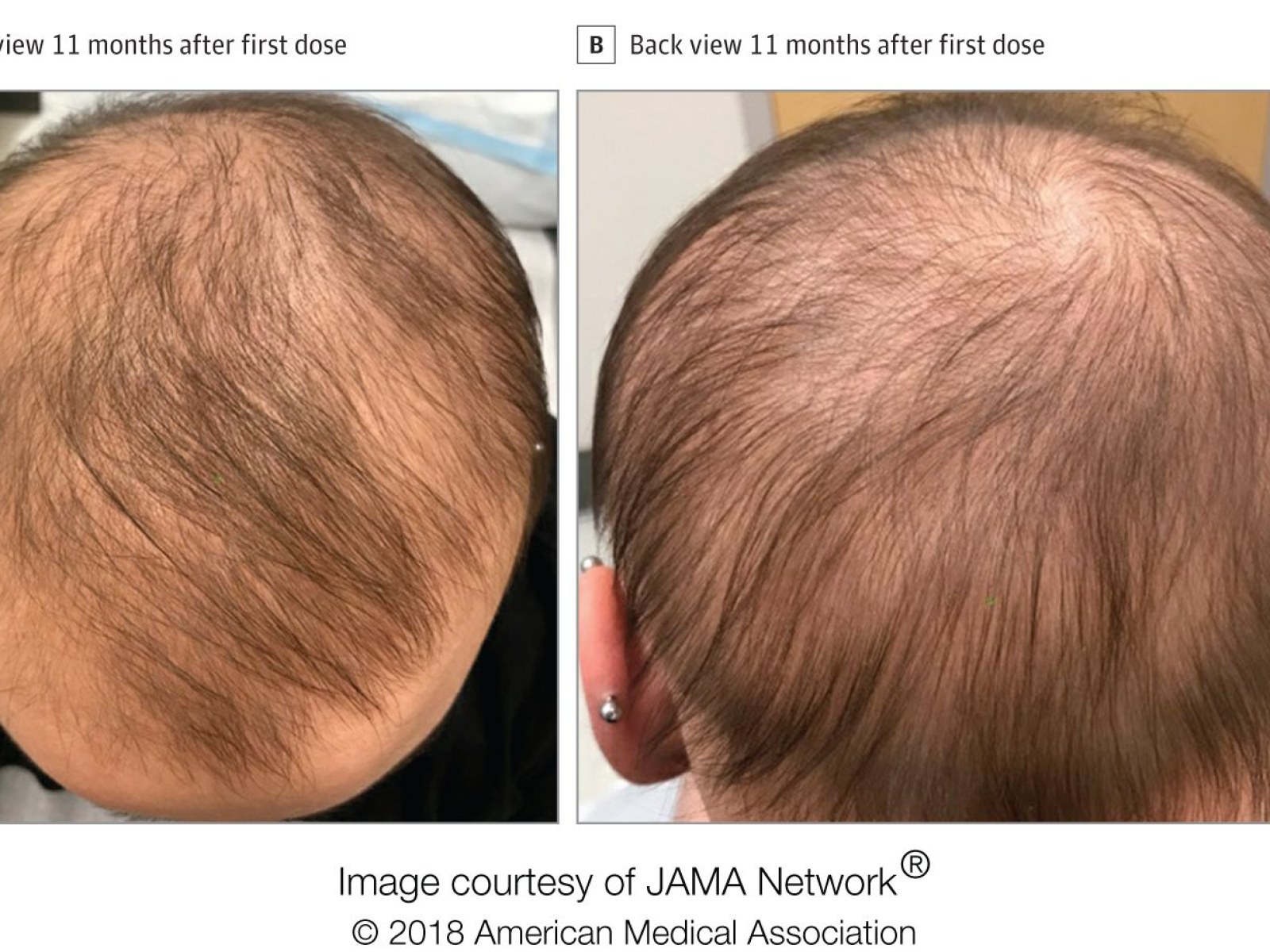 FDA-approved Eczema Drug Dupixent Causes Hair Regrowth in Alopecia Sufferer