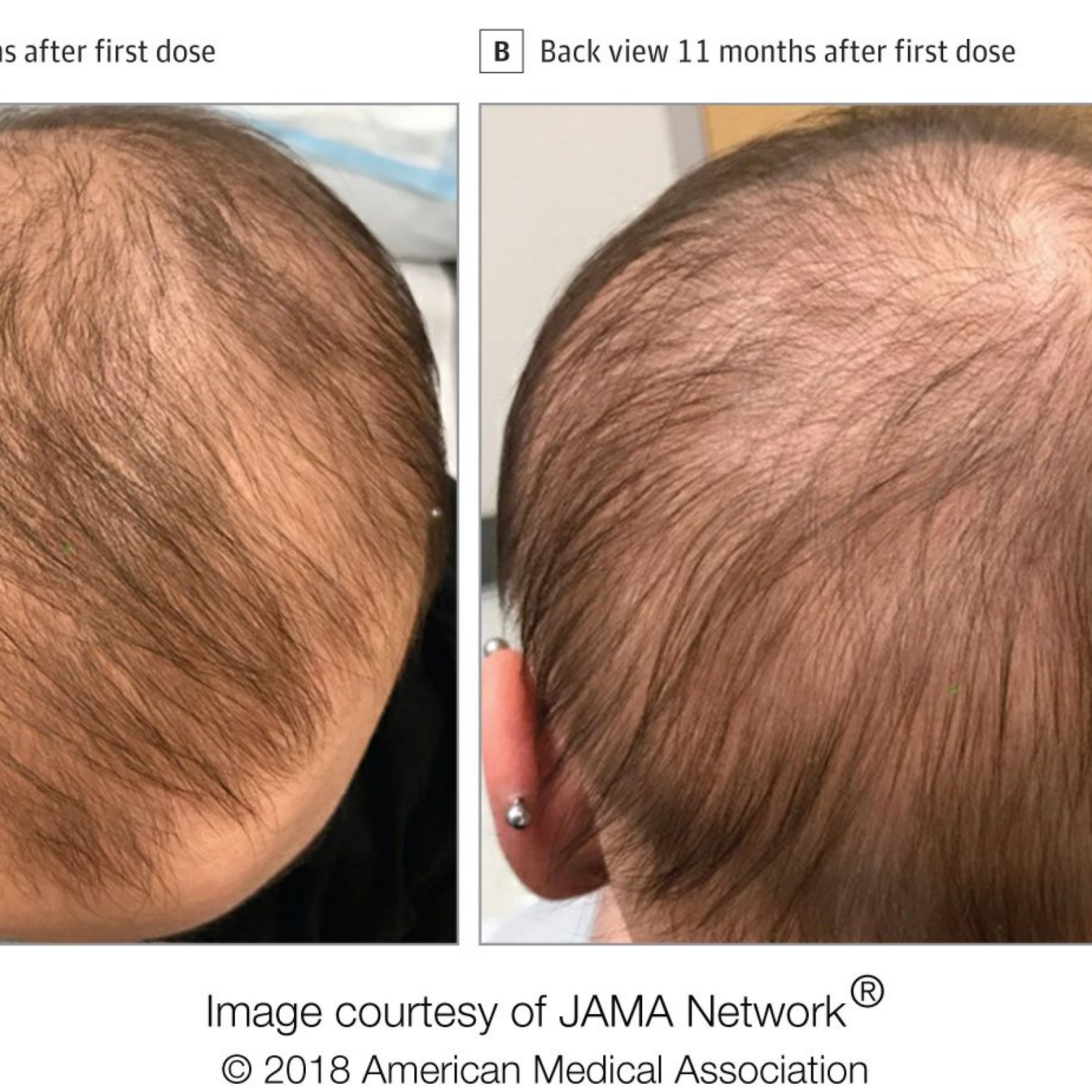 FDA-approved Eczema Drug Dupixent Causes Hair Regrowth in Alopecia Sufferer