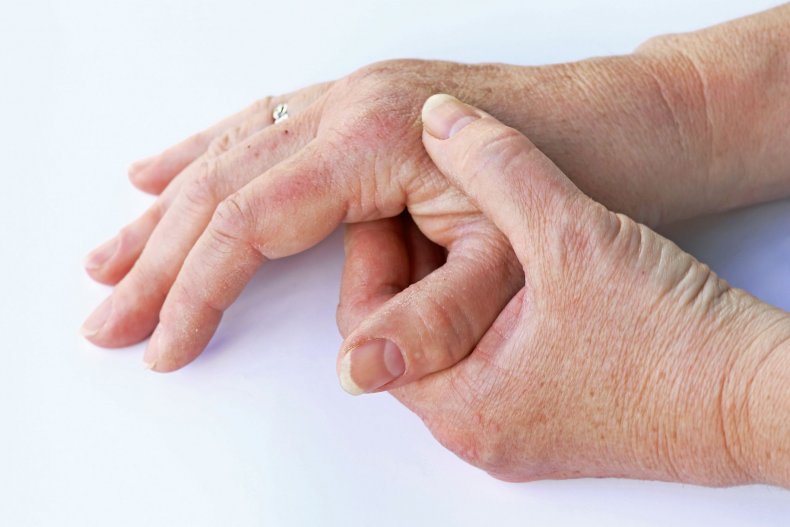 arthritis
