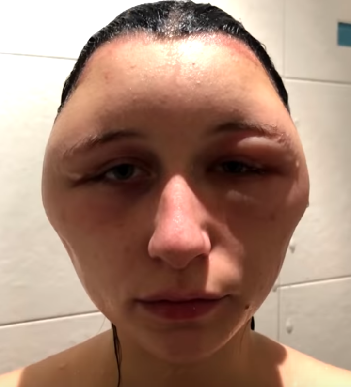 TikToker Goes Viral After Face Swells From Allergic Reaction To Hair TikToker Goes Viral After Face Swells From Allergic Reaction To Hair