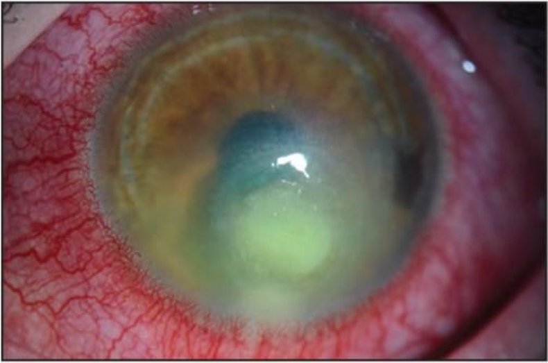 contact lens infection 