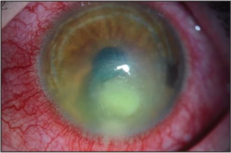 contact lens infection