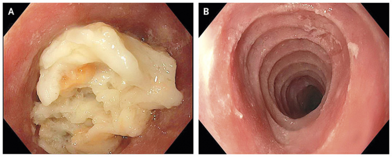 Trachealization Esophagus
