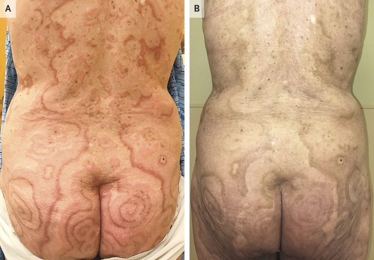 Cancer patterned skin Cancer patterned skin