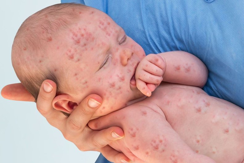 baby measles vaccine