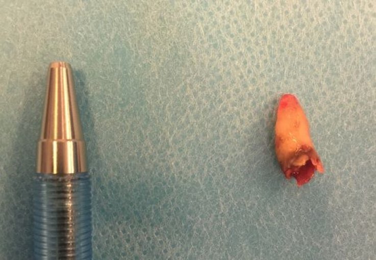 extracted tooth extracted tooth