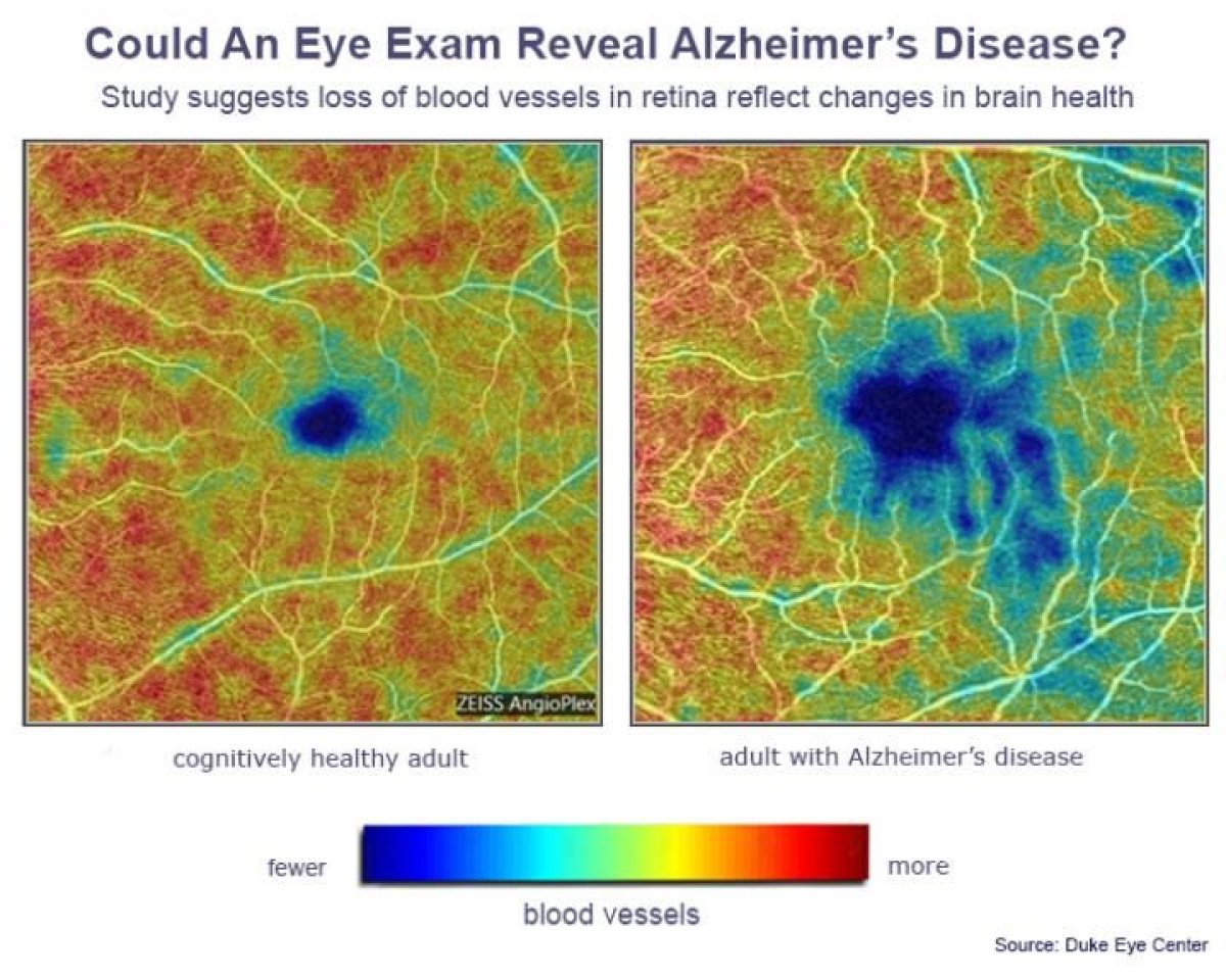 alzheimer's eye test