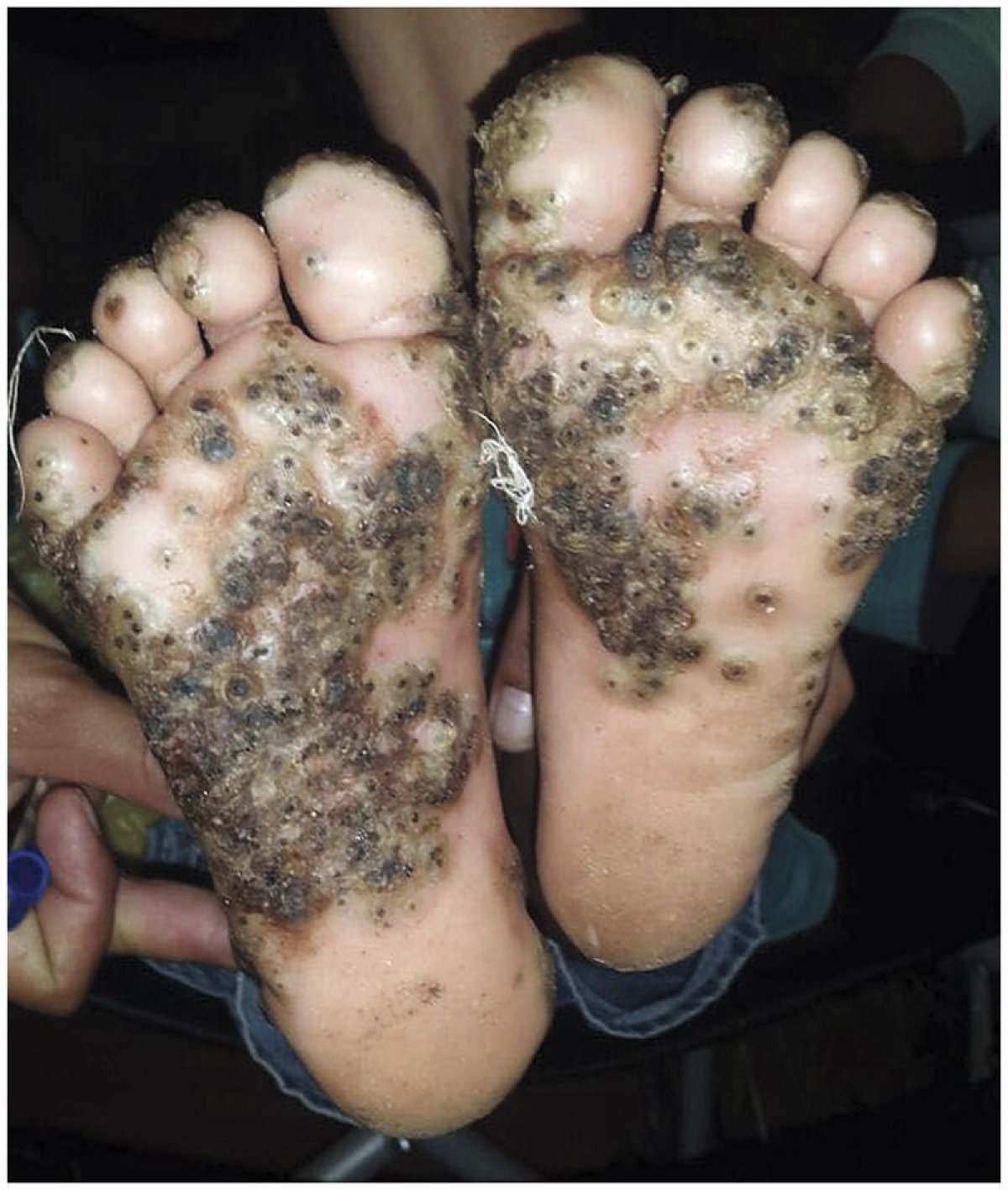 Horrific Image Shows Girl's Feet Infested With Sand Fleas After