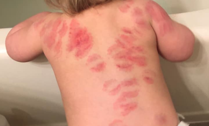 Tucson Child Bite Marks