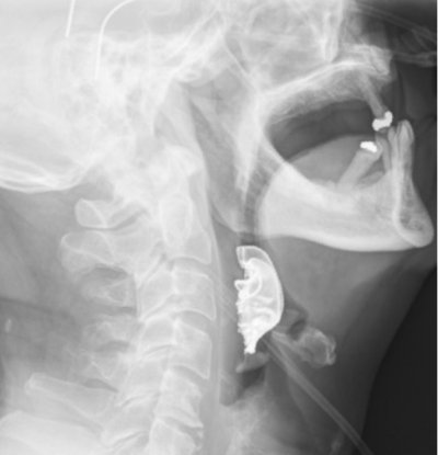 dentures throat dentures throat