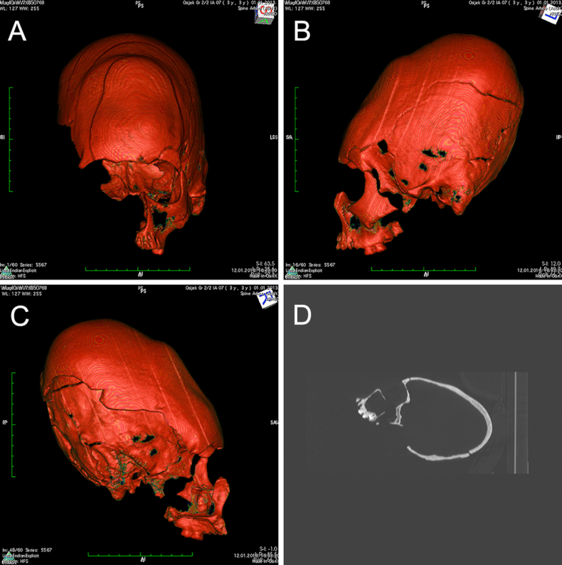 deformed skull
