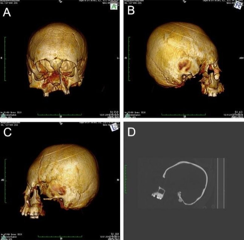 skull deformation