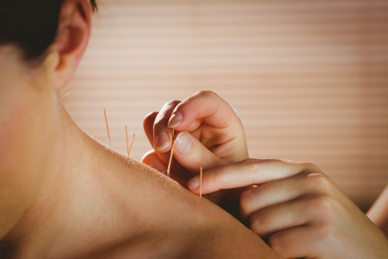 Acupuncture needles in shoulder