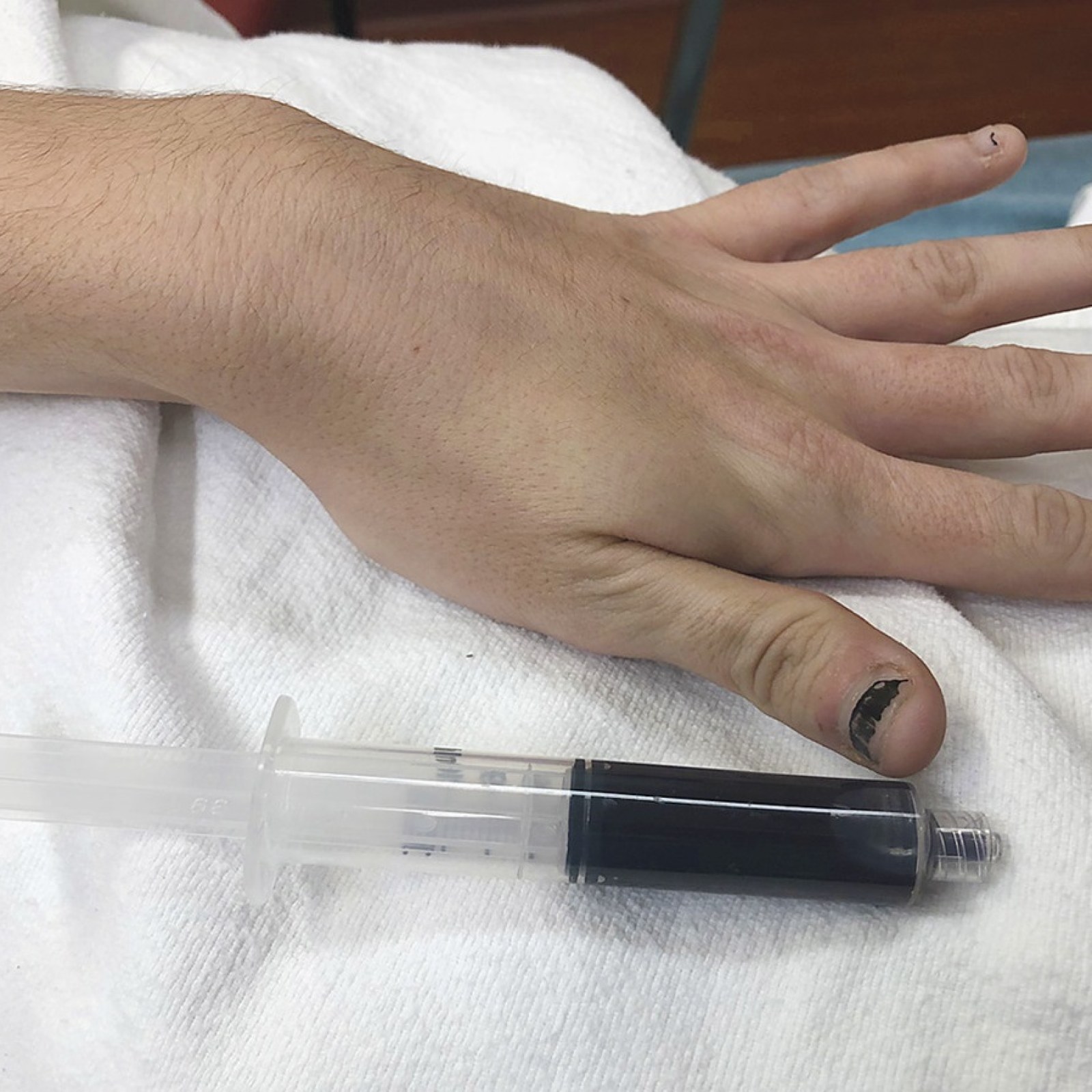 Woman S Blood Turns Black After Taking Medicine To Treat Her Toothache