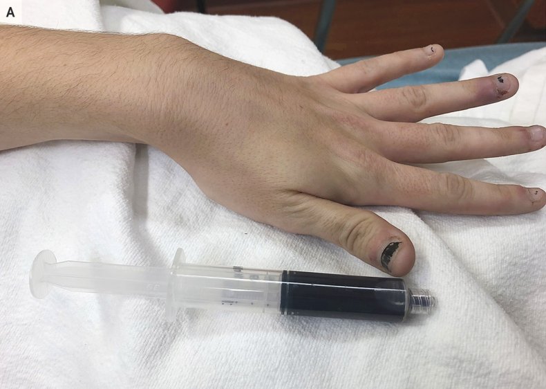 Acquired Methemoglobinemia, black blood, NEJM,