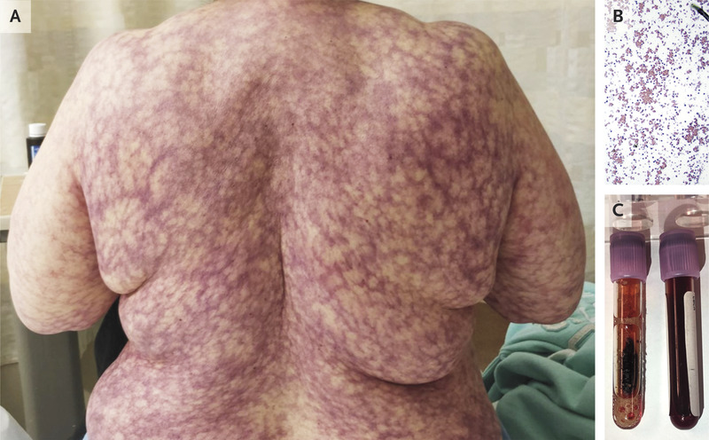 New York Cold Snap Causes Woman To Develop Purple Marbled Rash Across ...