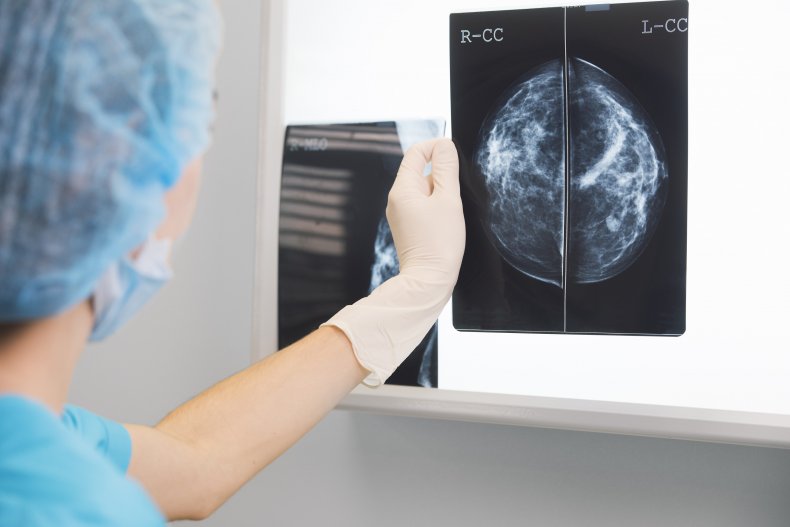 breast cancer, doctor, xray, healthy, getty, stock