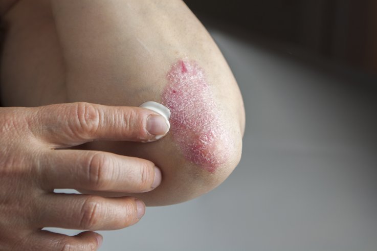 Psoriasis, skin, dermatology, stock, getty, Psoriasis, skin, dermatology, stock, getty,