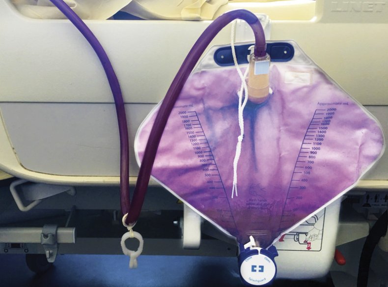 purple urine