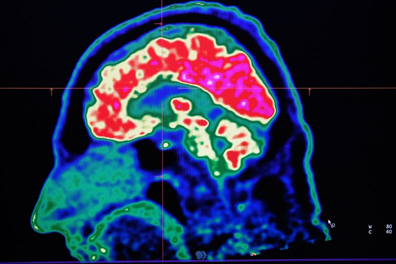 brain scan