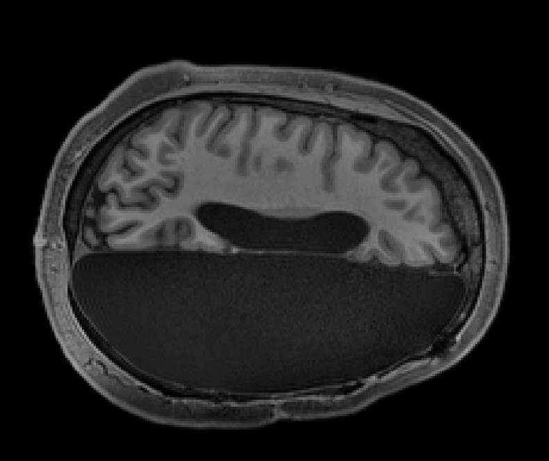 Brain scan