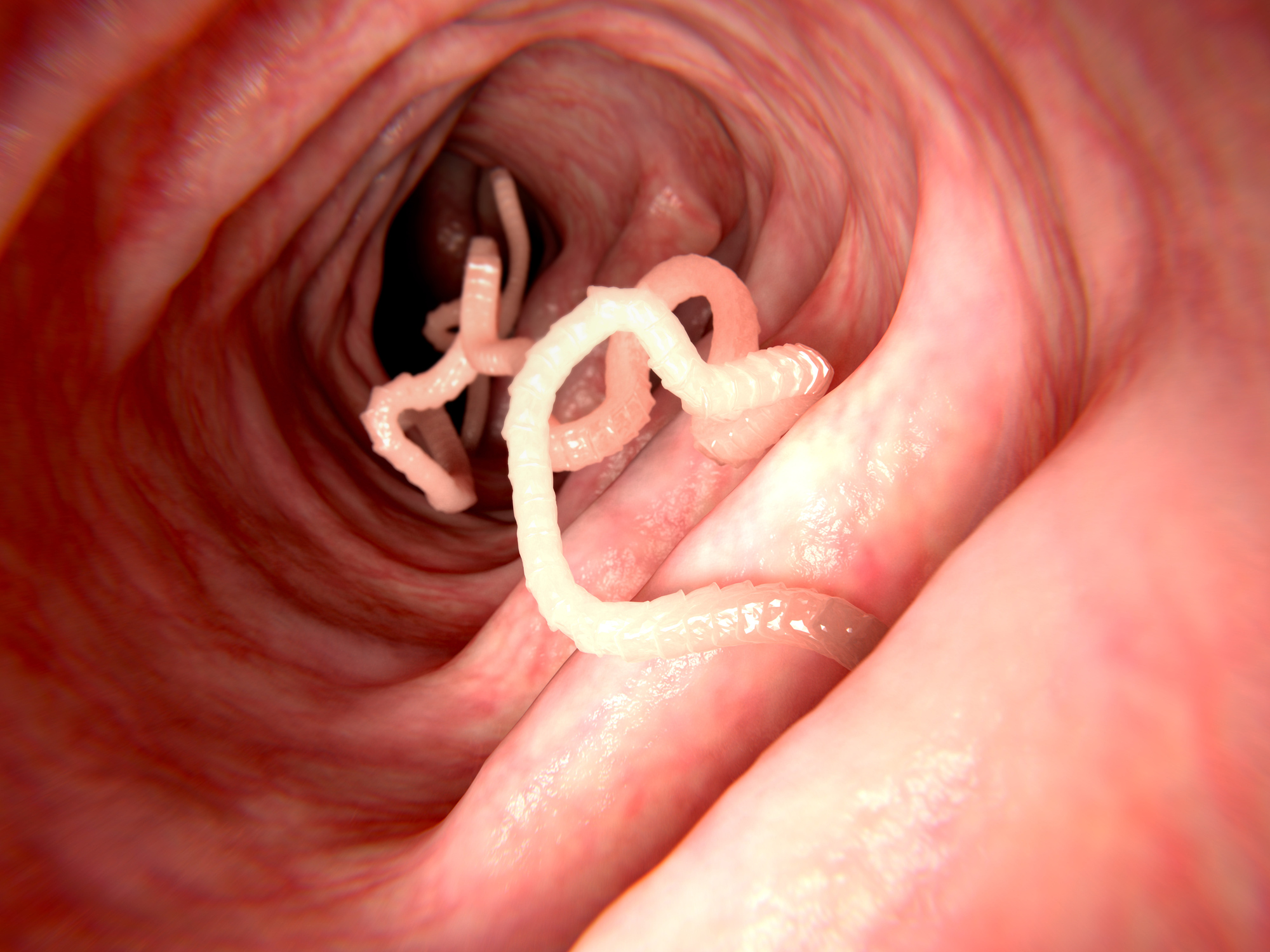 human tapeworm removal