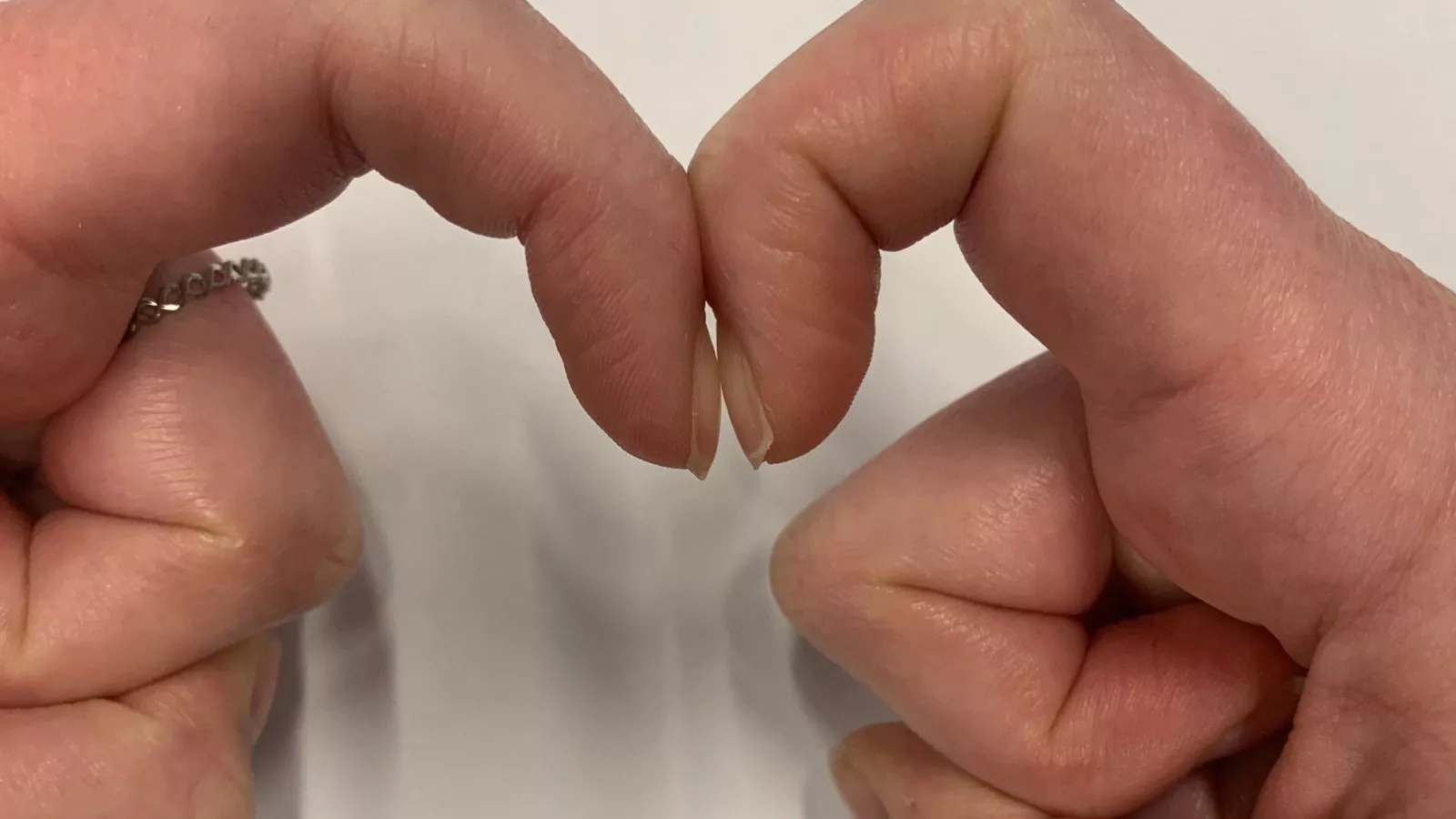 What your fingers say about you, Cancer research