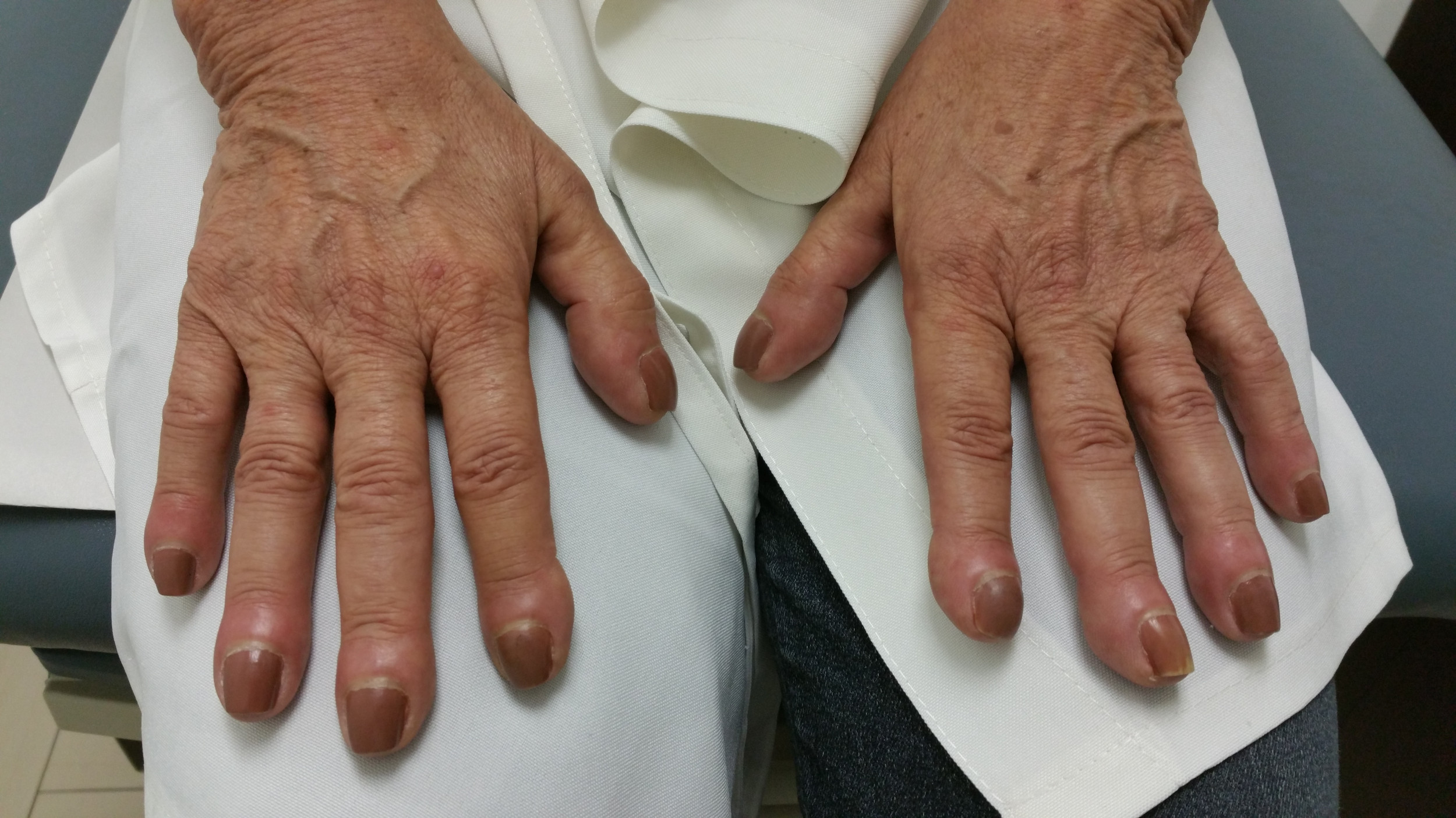 Can finger clubbing be a sign of COPD?