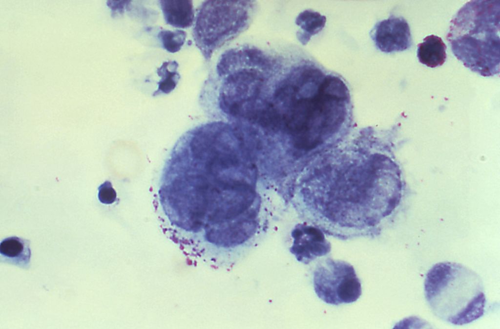 Researchers Find Link Between Herpes Strain And Developing Multiple ...