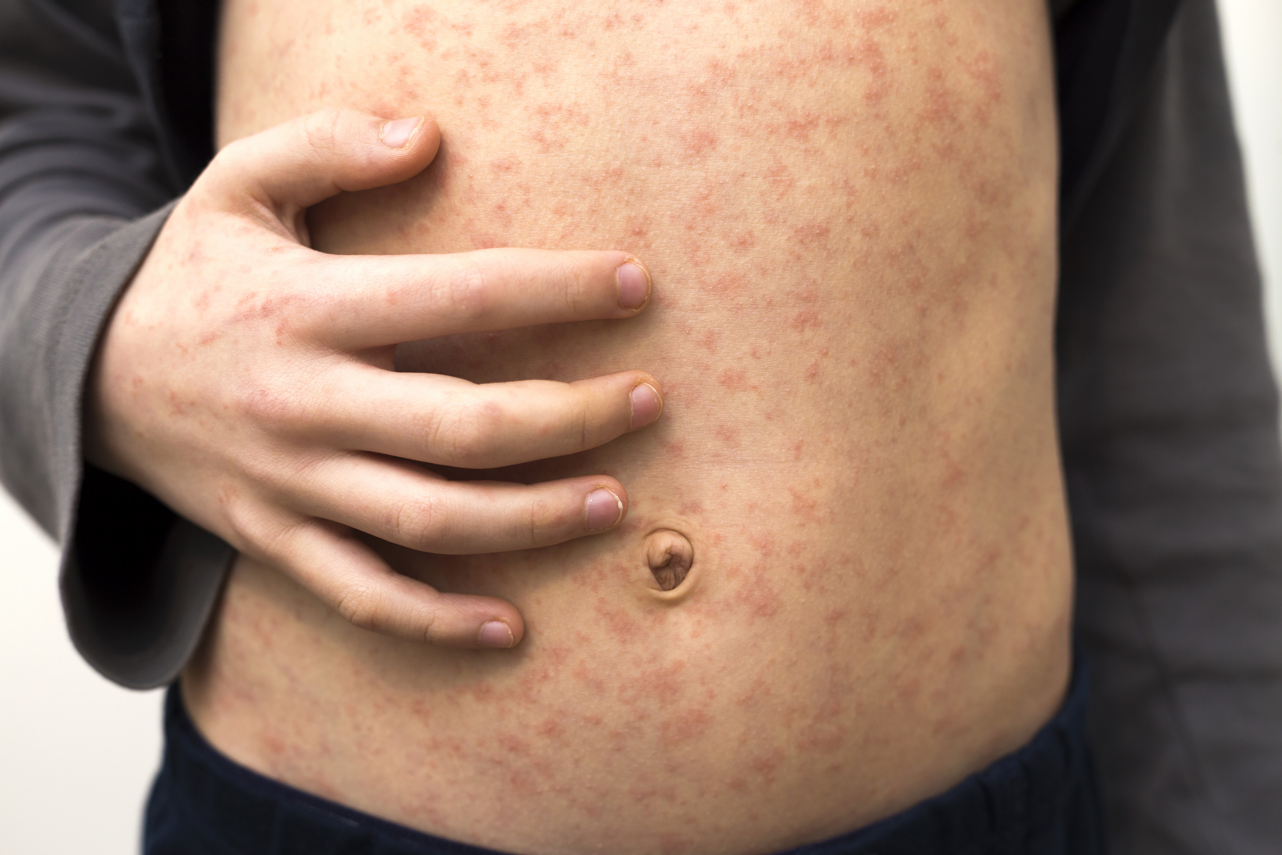 Measles Patients Passed Through Airports in Chicago, Virgini