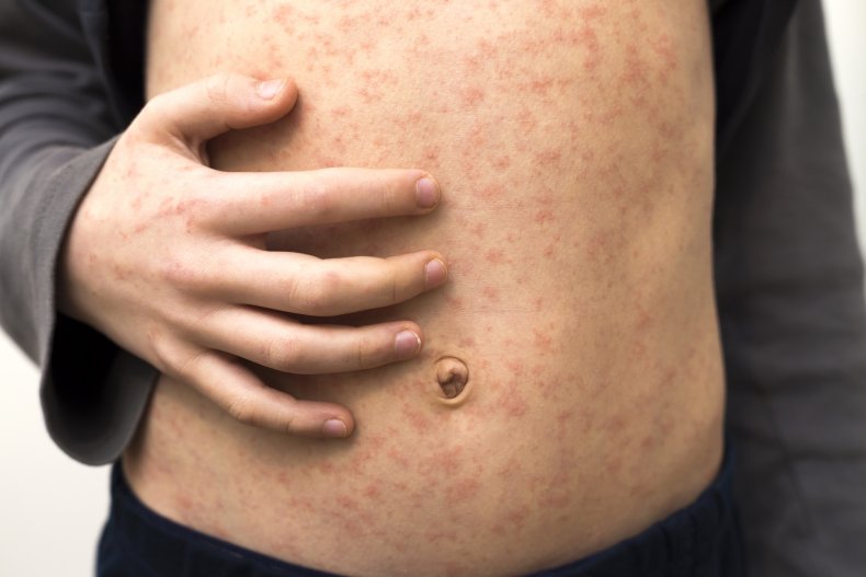 measles stock photo