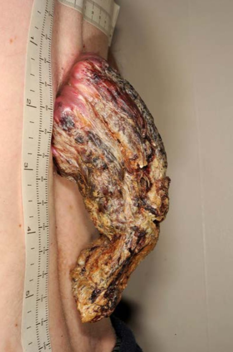 skin cancer, BMJ Case Reports,