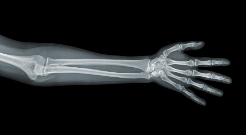 X-Ray of a human arm