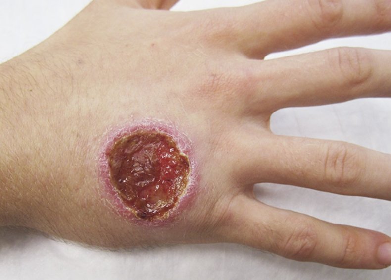 Cutaneous Leishmaniasis, NEJM,