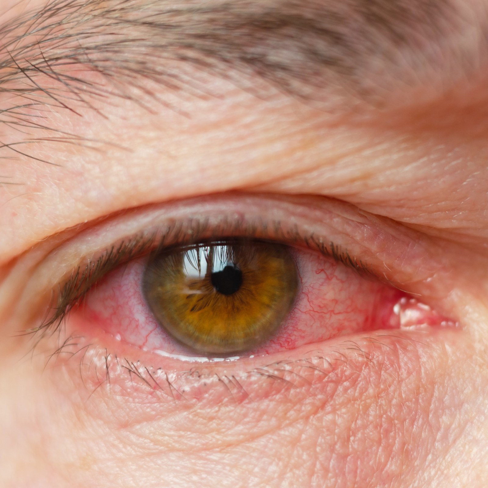 red-eyes-conjunctivitis-getty-stock.jpg
