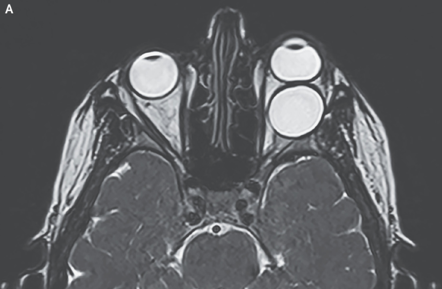 Woman's Eye Bulging from Socket Was Caused by a Baby Tapewormfilled