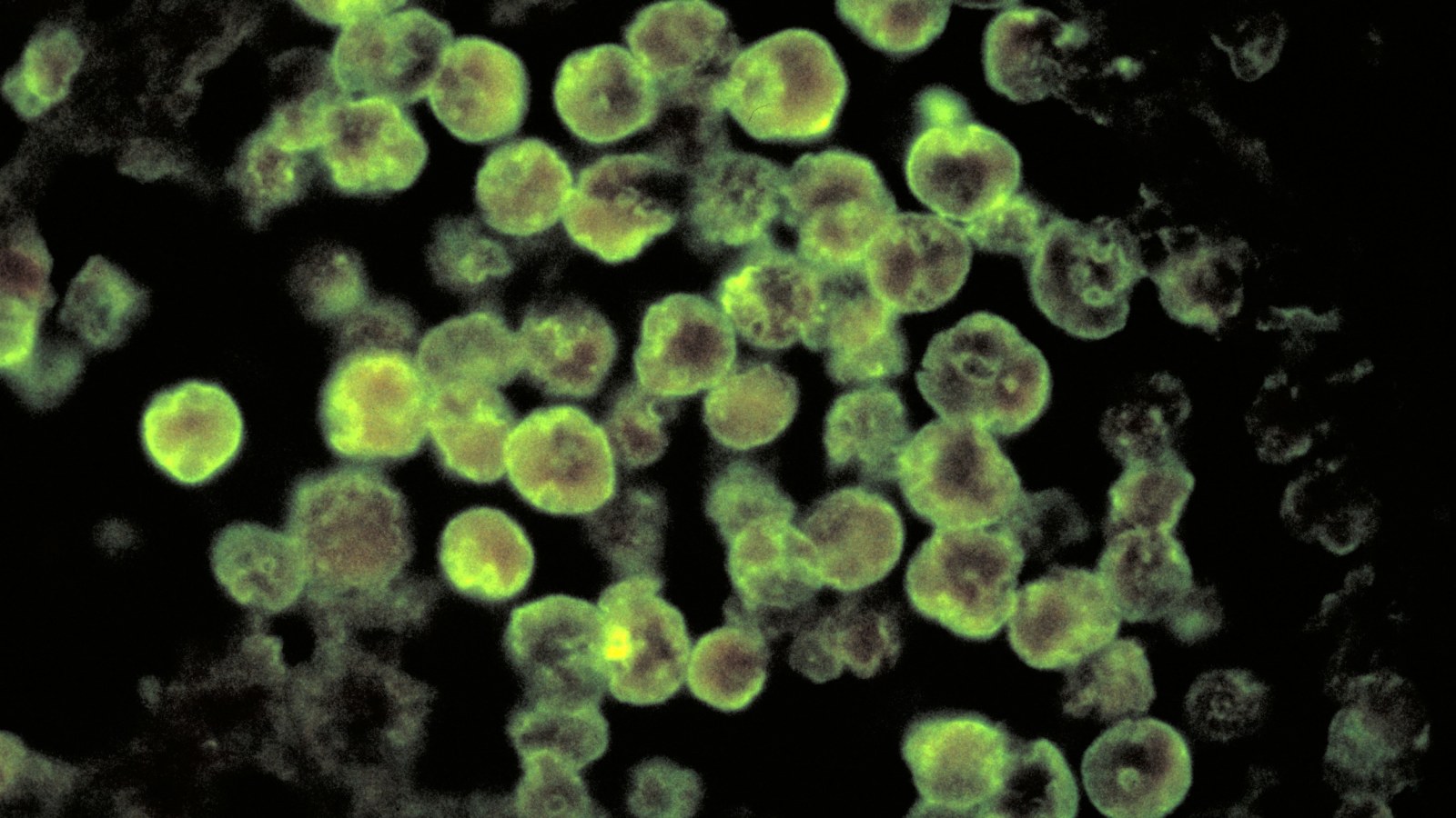Brain-eating Amoeba Reported in Rare Medical Case in Florida Brain-eating Amoeba Reported in Rare Medical Case in Florida